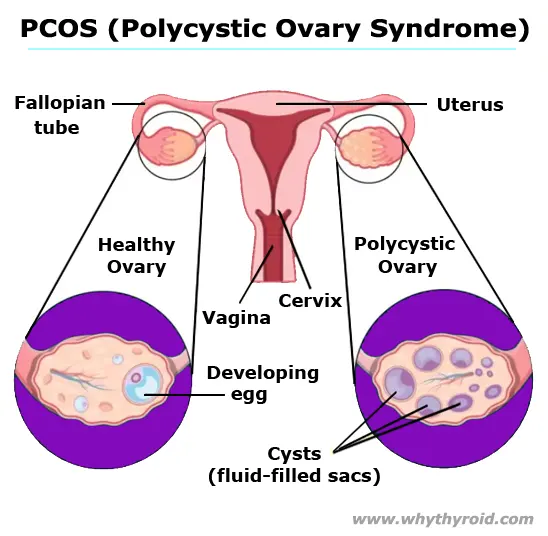 Polycystic Ovary Syndrome (PCOS) - Symptoms, Treatment - Why Thyroid